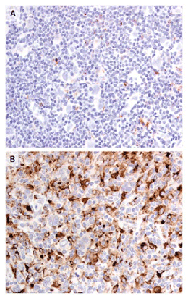 CD68+ macrophages obtained from a patient in treatment-success group and treatment failure group